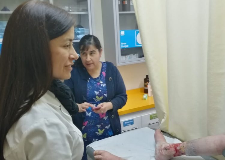 Cesfam de Quillón es piloto en Ñuble para curar las úlceras venosas