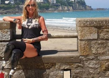 Mujer fue al hospital por una tos, pero era mucho peor: le amputaron las piernas, un brazo y 4 dedos