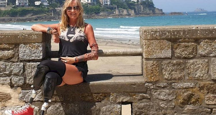 Mujer fue al hospital por una tos, pero era mucho peor: le amputaron las piernas, un brazo y 4 dedos