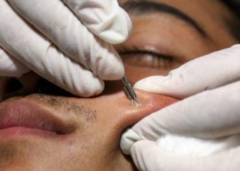 Forunculofilia: el extraño placer de ver granos reventados que cada día gana adeptos