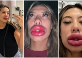 Impactante: así se le hincharon los labios a una mujer por una reacción alérgica