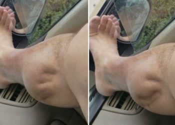 ¿Por qué ocurren los calambres?: conoce cómo aliviar sus síntomas y si es posible prevenirlos